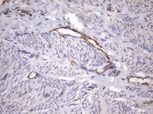 VWF / Von Willebrand Factor Antibody - IHC of paraffin-embedded Adenocarcinoma of Human endometrium tissue using anti-VWF mouse monoclonal antibody. (Heat-induced epitope retrieval by 1 mM EDTA in 10mM Tris, pH8.5, 120°C for 3min).