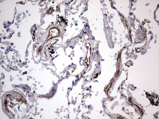 VWF / Von Willebrand Factor Antibody - IHC of paraffin-embedded Carcinoma of Human liver tissue using anti-VWF mouse monoclonal antibody. (Heat-induced epitope retrieval by 1 mM EDTA in 10mM Tris, pH8.5, 120°C for 3min).