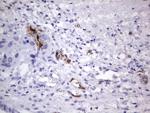 VWF / Von Willebrand Factor Antibody - IHC of paraffin-embedded Carcinoma of Human pancreas tissue using anti-VWF mouse monoclonal antibody. (Heat-induced epitope retrieval by 1 mM EDTA in 10mM Tris, pH8.5, 120°C for 3min).