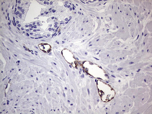 VWF / Von Willebrand Factor Antibody - IHC of paraffin-embedded Carcinoma of Human prostate tissue using anti-VWF mouse monoclonal antibody. (Heat-induced epitope retrieval by 1 mM EDTA in 10mM Tris, pH8.5, 120°C for 3min).