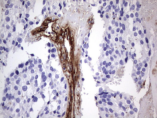 VWF / Von Willebrand Factor Antibody - IHC of paraffin-embedded Adenocarcinoma of Human breast tissue using anti-VWF mouse monoclonal antibody. (Heat-induced epitope retrieval by 1 mM EDTA in 10mM Tris, pH8.5, 120°C for 3min).