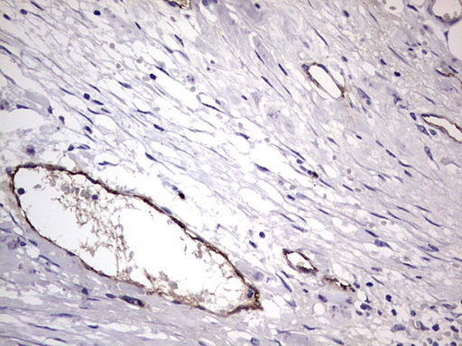 VWF / Von Willebrand Factor Antibody - IHC of paraffin-embedded Carcinoma of Human kidney tissue using anti-VWF mouse monoclonal antibody. (Heat-induced epitope retrieval by 1 mM EDTA in 10mM Tris, pH8.5, 120°C for 3min).
