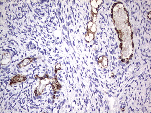 VWF / Von Willebrand Factor Antibody - IHC of paraffin-embedded Carcinoma of Human lung tissue using anti-VWF mouse monoclonal antibody. (Heat-induced epitope retrieval by 1 mM EDTA in 10mM Tris, pH8.5, 120°C for 3min).