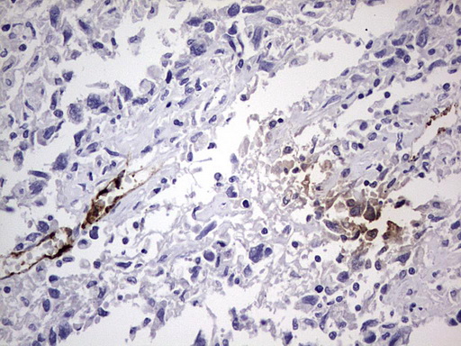 VWF / Von Willebrand Factor Antibody - IHC of paraffin-embedded Adenocarcinoma of Human ovary tissue using anti-VWF mouse monoclonal antibody. (Heat-induced epitope retrieval by 1 mM EDTA in 10mM Tris, pH8.5, 120°C for 3min).