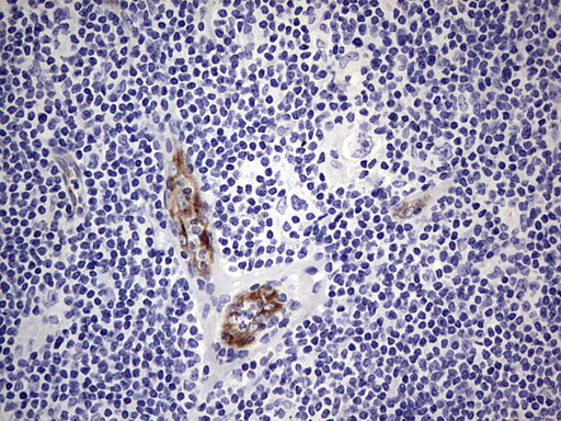 VWF / Von Willebrand Factor Antibody - IHC of paraffin-embedded Human lymphoma tissue using anti-VWF mouse monoclonal antibody. (Heat-induced epitope retrieval by 1 mM EDTA in 10mM Tris, pH8.5, 120°C for 3min).