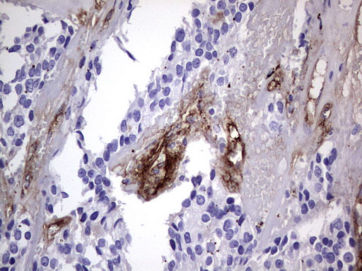VWF / Von Willebrand Factor Antibody - IHC of paraffin-embedded Adenocarcinoma of Human breast tissue using anti-VWF mouse monoclonal antibody. (Heat-induced epitope retrieval by 1 mM EDTA in 10mM Tris, pH8.5, 120°C for 3min).