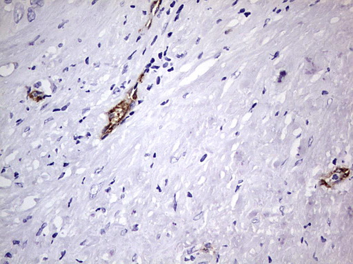 VWF / Von Willebrand Factor Antibody - IHC of paraffin-embedded Carcinoma of Human liver tissue using anti-VWF mouse monoclonal antibody. (Heat-induced epitope retrieval by 1 mM EDTA in 10mM Tris, pH8.5, 120°C for 3min).