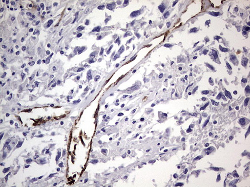 VWF / Von Willebrand Factor Antibody - IHC of paraffin-embedded Adenocarcinoma of Human ovary tissue using anti-VWF mouse monoclonal antibody. (Heat-induced epitope retrieval by 1 mM EDTA in 10mM Tris, pH8.5, 120°C for 3min).