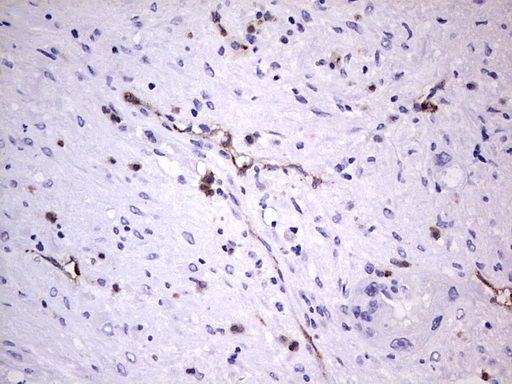 VWF / Von Willebrand Factor Antibody - IHC of paraffin-embedded Carcinoma of Human pancreas tissue using anti-VWF mouse monoclonal antibody. (Heat-induced epitope retrieval by 1 mM EDTA in 10mM Tris, pH8.5, 120°C for 3min).