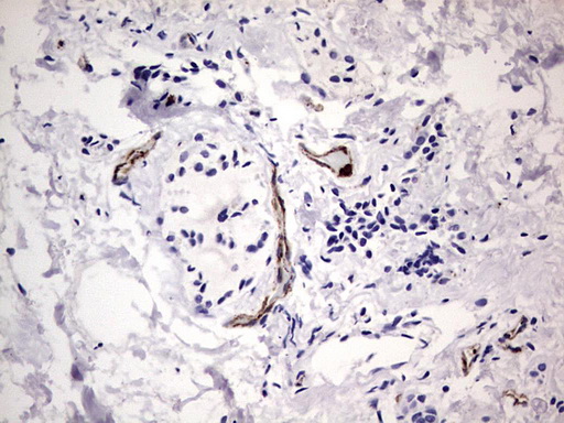 VWF / Von Willebrand Factor Antibody - IHC of paraffin-embedded Human thyroid tissue using anti-VWF mouse monoclonal antibody. (Heat-induced epitope retrieval by 1 mM EDTA in 10mM Tris, pH8.5, 120°C for 3min).