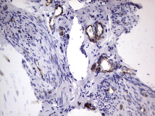 VWF / Von Willebrand Factor Antibody - IHC of paraffin-embedded Adenocarcinoma of Human endometrium tissue using anti-VWF mouse monoclonal antibody. (Heat-induced epitope retrieval by 1 mM EDTA in 10mM Tris, pH8.5, 120°C for 3min).