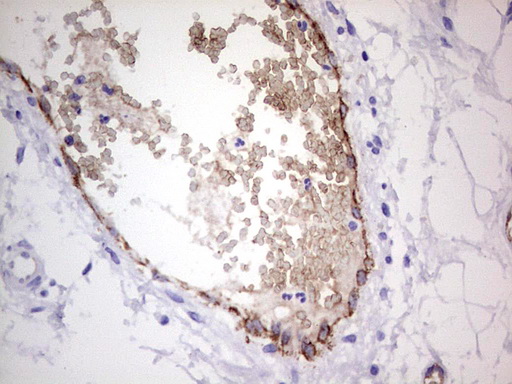 VWF / Von Willebrand Factor Antibody - IHC of paraffin-embedded Carcinoma of Human bladder tissue using anti-VWF mouse monoclonal antibody. (Heat-induced epitope retrieval by 1 mM EDTA in 10mM Tris, pH8.5, 120°C for 3min).