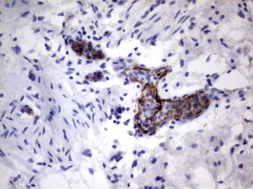 VWF / Von Willebrand Factor Antibody - IHC of paraffin-embedded Human bladder tissue using anti-VWF mouse monoclonal antibody. (Heat-induced epitope retrieval by 1 mM EDTA in 10mM Tris, pH8.5, 120°C for 3min).