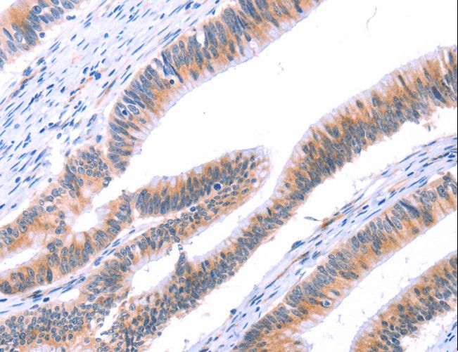 VWF / Von Willebrand Factor Antibody - Immunohistochemistry of paraffin-embedded Human lung cancer using VWF Polyclonal Antibody at dilution of 1:50.