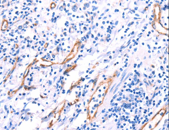VWF / Von Willebrand Factor Antibody - Immunohistochemistry of paraffin-embedded Human gastric cancer using VWF Polyclonal Antibody at dilution of 1:50.