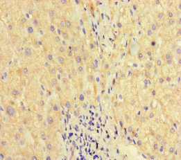 WAC Antibody - Immunohistochemistry of paraffin-embedded human liver cancer at dilution of 1:100