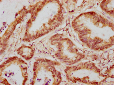 WAPAL / WAPL Antibody - IHC image of WAPL Antibody diluted at 1:300 and staining in paraffin-embedded human colon cancer performed on a Leica BondTM system. After dewaxing and hydration, antigen retrieval was mediated by high pressure in a citrate buffer (pH 6.0). Section was blocked with 10% normal goat serum 30min at RT. Then primary antibody (1% BSA) was incubated at 4°C overnight. The primary is detected by a biotinylated secondary antibody and visualized using an HRP conjugated SP system.