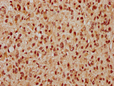 WAPAL / WAPL Antibody - IHC image of WAPL Antibody diluted at 1:300 and staining in paraffin-embedded human glioma performed on a Leica BondTM system. After dewaxing and hydration, antigen retrieval was mediated by high pressure in a citrate buffer (pH 6.0). Section was blocked with 10% normal goat serum 30min at RT. Then primary antibody (1% BSA) was incubated at 4°C overnight. The primary is detected by a biotinylated secondary antibody and visualized using an HRP conjugated SP system.