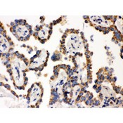 WAS / WASP Antibody - WASP antibody IHC-paraffin. IHC(P): Human Lung Cancer Tissue.