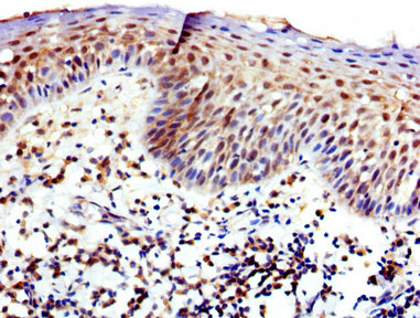 WAS / WASP Antibody - Immunohistochemistry image at a dilution of 1:400 and staining in paraffin-embedded human tonsil tissue performed on a Leica BondTM system. After dewaxing and hydration, antigen retrieval was mediated by high pressure in a citrate buffer (pH 6.0) . Section was blocked with 10% normal goat serum 30min at RT. Then primary antibody (1% BSA) was incubated at 4 °C overnight. The primary is detected by a biotinylated secondary antibody and visualized using an HRP conjugated SP system.