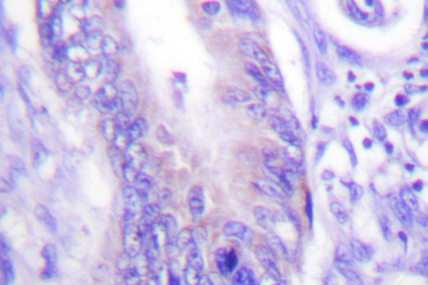 WASF1 / WAVE Antibody - IHC of WAVE1 (I119) pAb in paraffin-embedded human colon carcinoma brain tissue.