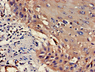 WASF1 / WAVE Antibody - Immunohistochemistry of paraffin-embedded human cervical cancer at dilution of 1:100