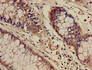 WASF1 / WAVE Antibody - Immunohistochemistry of paraffin-embedded human colon cancer at dilution of 1:100