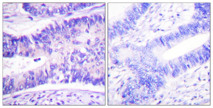 WASF1 / WAVE Antibody - Immunohistochemistry analysis of paraffin-embedded human colon carcinoma, using WAVE1 (Phospho-Tyr125) Antibody. The picture on the right is blocked with the phospho peptide.