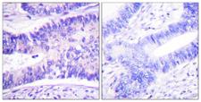 WASF1 / WAVE Antibody - P-peptide - + Immunohistochemistry analysis of paraffin-embedded human colon carcinoma tissue using WAVE1 (Phospho-Tyr125) antibody.