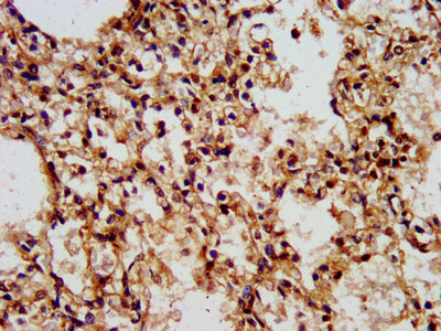 WASF2 / SCAR2 Antibody - Immunohistochemistry image at a dilution of 1:500 and staining in paraffin-embedded human lung tissue performed on a Leica BondTM system. After dewaxing and hydration, antigen retrieval was mediated by high pressure in a citrate buffer (pH 6.0) . Section was blocked with 10% normal goat serum 30min at RT. Then primary antibody (1% BSA) was incubated at 4 °C overnight. The primary is detected by a biotinylated secondary antibody and visualized using an HRP conjugated SP system.
