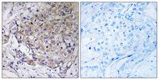 WASF3 Antibody - Immunohistochemistry analysis of paraffin-embedded human breast carcinoma tissue, using WASF3 Antibody. The picture on the right is blocked with the synthesized peptide.