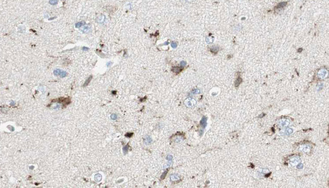 WASF3 Antibody - 1:100 staining human brain carcinoma tissue by IHC-P. The sample was formaldehyde fixed and a heat mediated antigen retrieval step in citrate buffer was performed. The sample was then blocked and incubated with the antibody for 1.5 hours at 22°C. An HRP conjugated goat anti-rabbit antibody was used as the secondary.