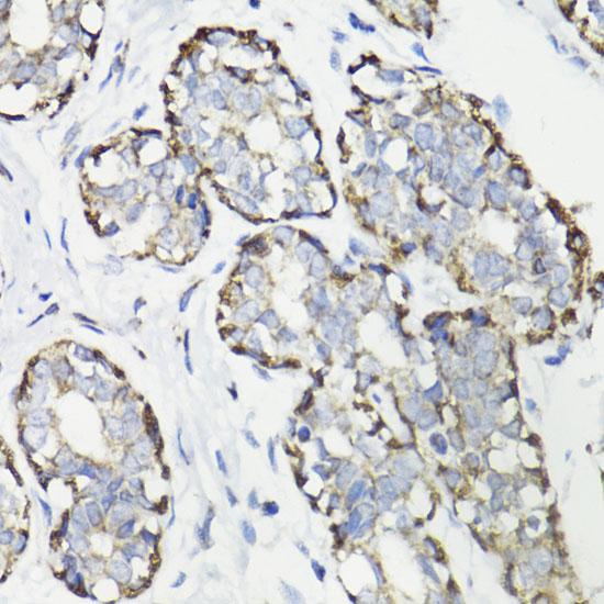 WASF3 Antibody - Immunohistochemistry of paraffin-embedded Human breast cancer using WASF3 Polyclonal Antibody at dilution of 1:100 (40x lens).