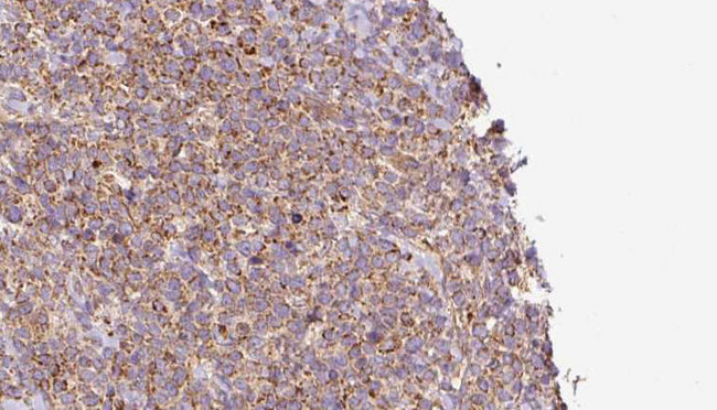 WBP2NL Antibody - 1:100 staining human lymph carcinoma tissue by IHC-P. The sample was formaldehyde fixed and a heat mediated antigen retrieval step in citrate buffer was performed. The sample was then blocked and incubated with the antibody for 1.5 hours at 22°C. An HRP conjugated goat anti-rabbit antibody was used as the secondary.