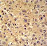 WBSCR27 Antibody - WBSCR27 antibody immunohistochemistry of formalin-fixed and paraffin-embedded human hepatocarcinoma followed by peroxidase-conjugated secondary antibody and DAB staining.