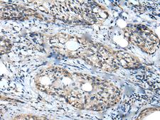 WDFY2 Antibody - Immunohistochemistry of paraffin-embedded Human cervical cancer tissue  using WDFY2 Polyclonal Antibody at dilution of 1:40(×200)
