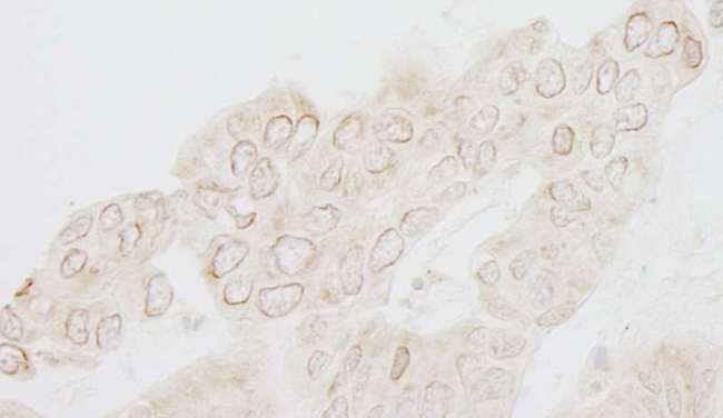 WDFY3 / ALFY Antibody - Detection of Human WDFY3 by Immunohistochemistry. Sample: FFPE section of human ovarian carcinoma. Antibody: Affinity purified rabbit anti-WDFY3 used at a dilution of 1:250.