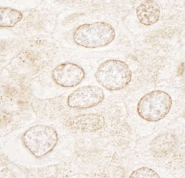WDFY3 / ALFY Antibody - Detection of Human WDFY3 by Immunohistochemistry. Sample: FFPE section of human breast carcinoma. Antibody: Affinity purified rabbit anti-WDFY3 used at a dilution of 1:250.