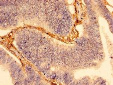 WDFY3 / ALFY Antibody - Immunohistochemistry image of paraffin-embedded human colon cancer at a dilution of 1:100