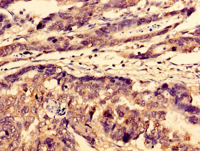 WDFY3 / ALFY Antibody - Immunohistochemistry image of paraffin-embedded human gastric cancer at a dilution of 1:100