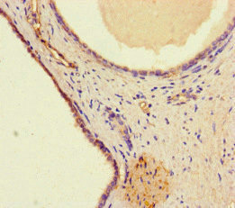 WDFY4 Antibody - Immunohistochemistry of paraffin-embedded human prostate cancer at dilution of 1:100