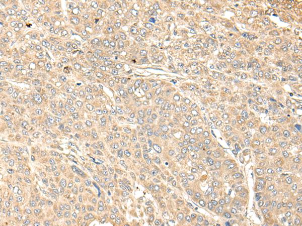 WDFY4 Antibody - Immunohistochemistry of paraffin-embedded Human liver cancer tissue  using WDFY4 Polyclonal Antibody at dilution of 1:50(×200)