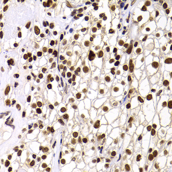 WDR11 / PHIP Antibody - Immunohistochemistry of paraffin-embedded human well-differentiated squamous skin carcinoma tissue.