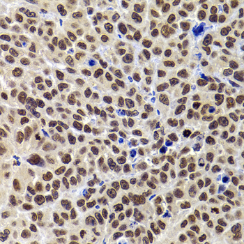 WDR11 / PHIP Antibody - Immunohistochemistry of paraffin-embedded human kidney cancer tissue.
