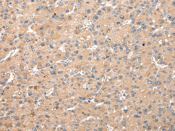 WDR18 Antibody - Immunohistochemistry of paraffin-embedded Human liver cancer tissue  using WDR18 Polyclonal Antibody at dilution of 1:25(×200)