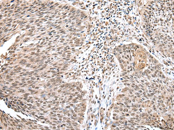 WDR18 Antibody - Immunohistochemistry of paraffin-embedded Human lung cancer tissue  using WDR18 Polyclonal Antibody at dilution of 1:25(×200)