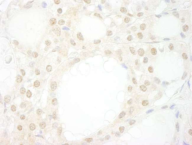WDR20 Antibody - Detection of Human WDR20 by Immunohistochemistry. Sample: FFPE section of human thyroid carcinoma. Antibody: Affinity purified rabbit anti-WDR20 used at a dilution of 1:250.