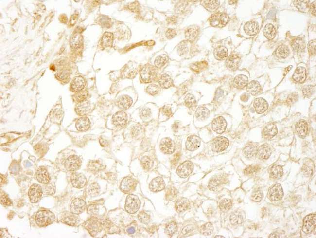 WDR20 Antibody - Detection of Human WDR20 by Immunohistochemistry. Sample: FFPE section of human seminoma. Antibody: Affinity purified rabbit anti-WDR20 used at a dilution of 1:250.