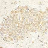 WDR20 Antibody - Detection of Human WDR20 by Immunohistochemistry. Sample: FFPE section of human small cell lung cancer. Antibody: Affinity purified rabbit anti-WDR20 used at a dilution of 1:1000 (1 ug/ml). Detection: DAB.