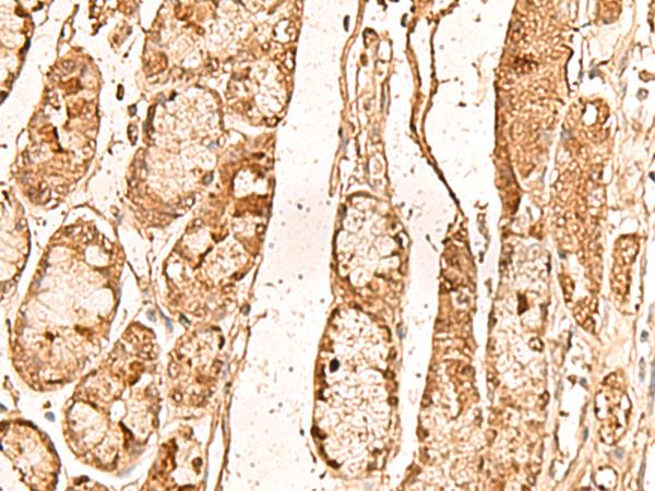 WDR33 Antibody - Immunohistochemistry of paraffin-embedded Human liver cancer tissue  using WDR33 Polyclonal Antibody at dilution of 1:65(×200)